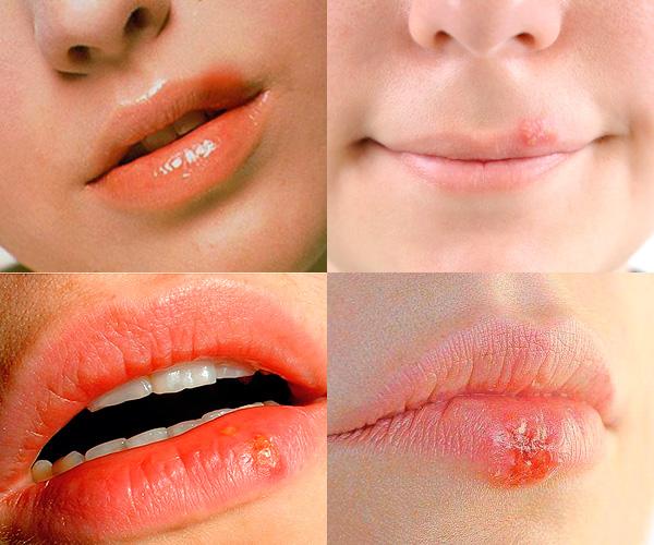 What does herpes look like on the lips?