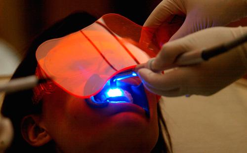 Blanchiment des dents au laser