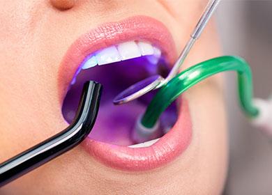 Blanqueamiento dental con láser