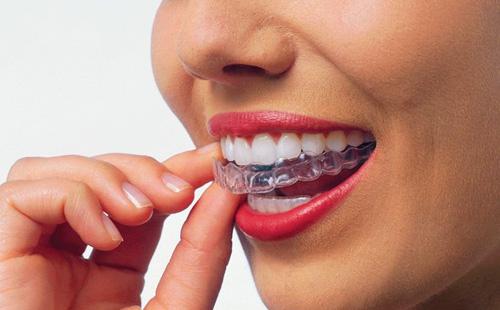 Protège-dents pour le blanchiment des dents