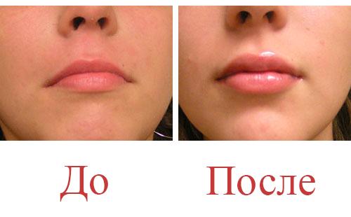 Labios antes y después del procedimiento.