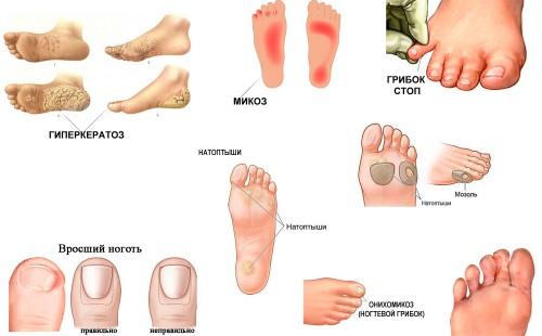 Hyperkératose des pieds, mycose des pieds, champignons des pieds, cors, champignons des ongles, ongles incarnés