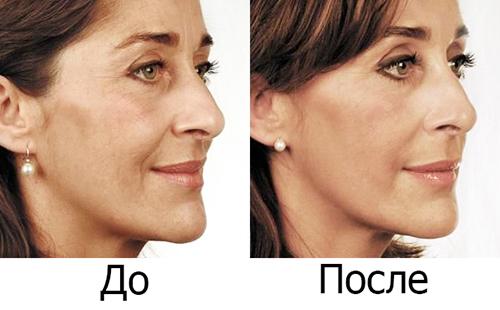 A pretty woman became even more beautiful after applying the Botox pharmacy