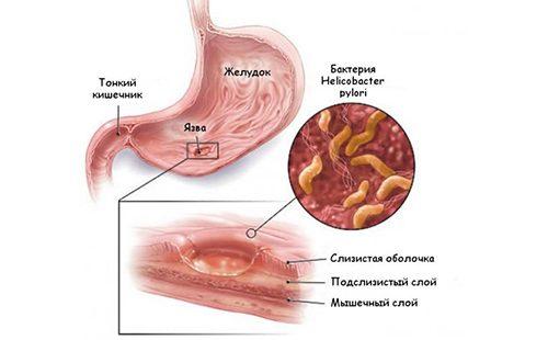 The figure shows the mechanism of formation of stomach ulcers