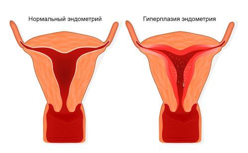 Endometrial tissue proliferation pattern