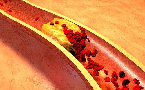 Arterial cholesterol plaque