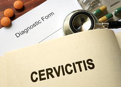 Cervicitis of the cervix